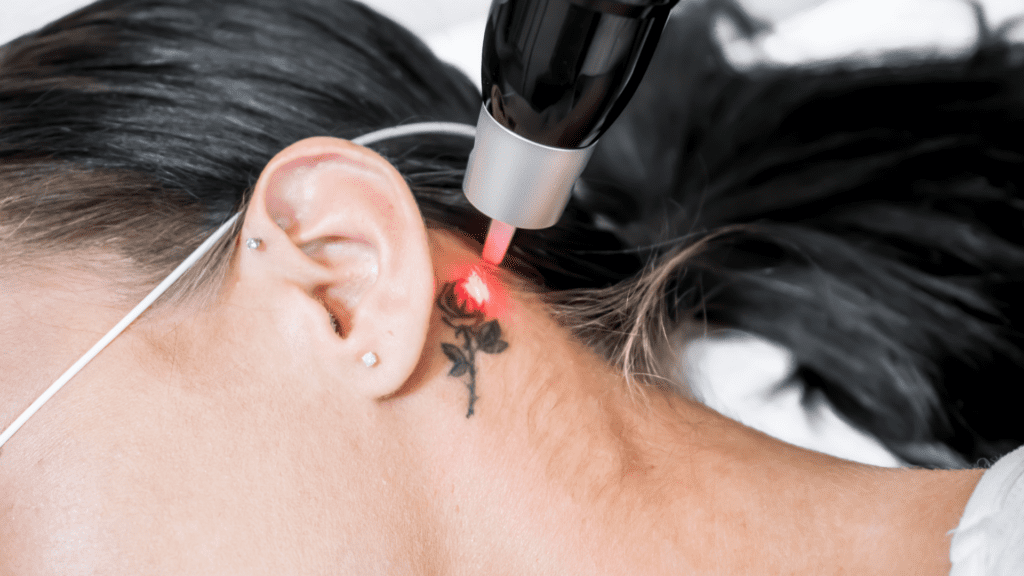 laser-tattoo-removal-ear