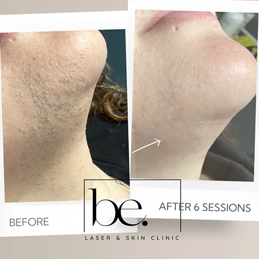 laser-hair-removal-female-chin