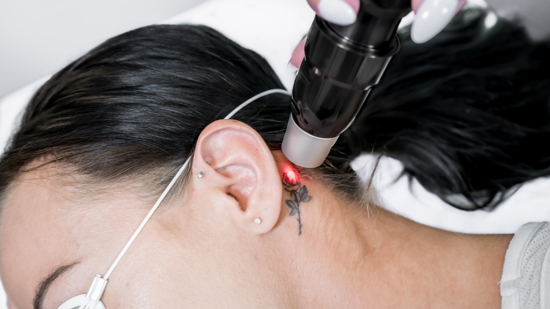 Laser Tattoo Removal Taunton, Trusted Experts